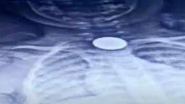 صورة العملة في الأشعة