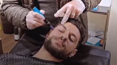 جلسة لإزالة الشعر بالليزر
