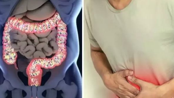 القولون التقرحي 