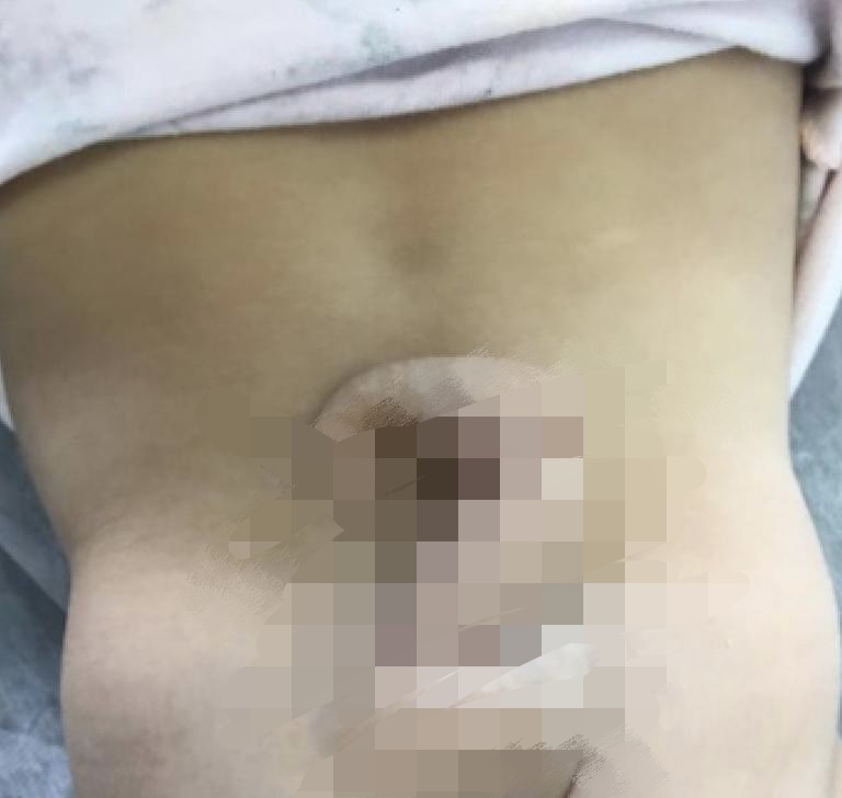 ولادة طفلة بـ ذيل في ظهرها