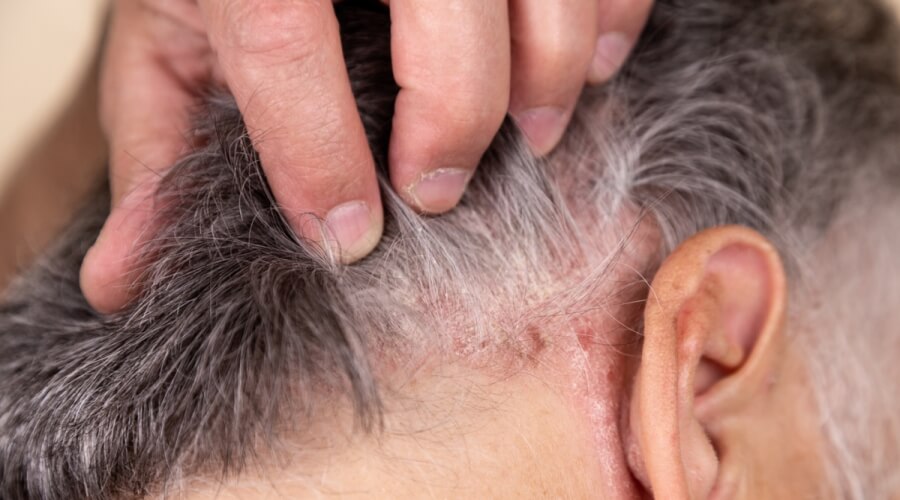 صدفية الرأس