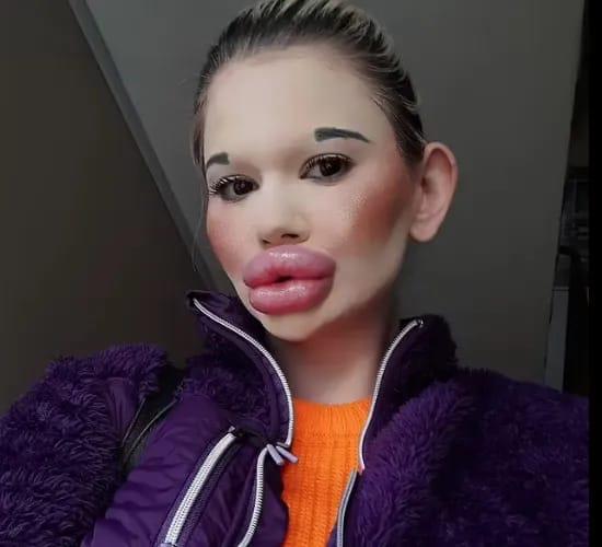 المراة البرتغالية بعد تكبير الشفاه