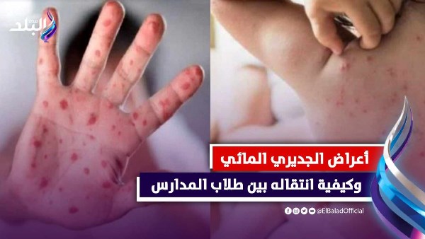 الجدري المائي .. كيفية العلاج منه بعد إصابة 24 طالبا