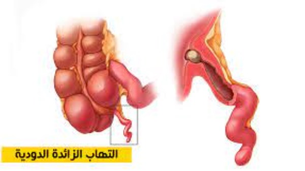 اعراض الزائدة