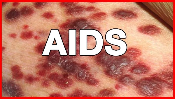 الايدز