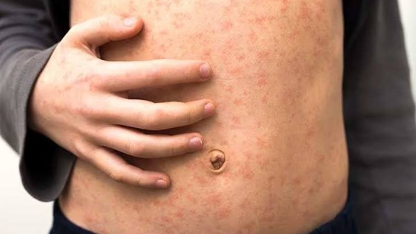 وباء الحصبة ينتشر في إسرائيل بوتيرة متسارعة
