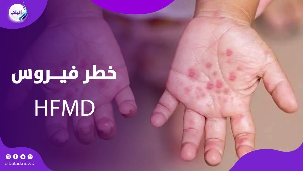 فيروس خطير يهدد الأطفال