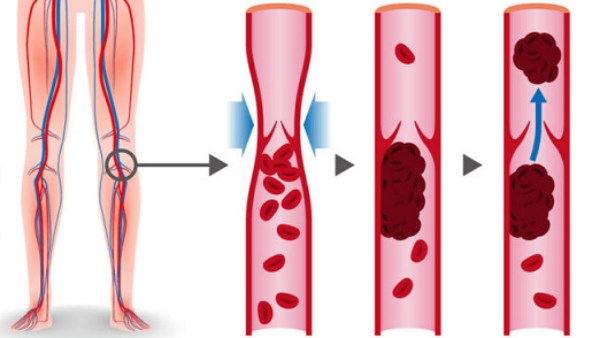 متلازمة ما بعد الجلطة.. العلامات وعوامل الخطر  