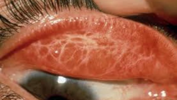 مصر تتلقى شهادة الخلو من التراكوما.. تعرف على المرض وأعراضه وطرق الوقاية  