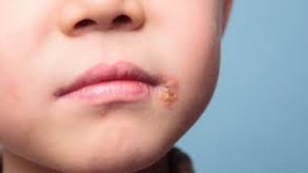 الهربس عند الأطفال.. كيف تميّز الأعراض وسط تشابهها مع نزلات البرد؟