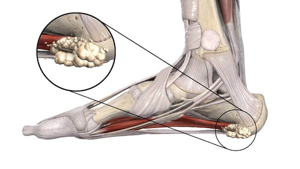 الشوكة العظمية.. كيف تكتشفها؟ وكيف تتعامل مع ألمها؟