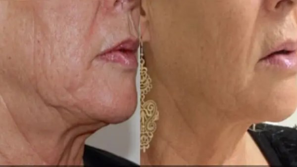 حكم إجراء عملية شد الوجه لإزالة التجاعيد.. الإفتاء توضح 