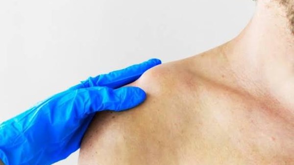 ما الذي يحدث عند كسر الترقوة؟ ما الذي يحدث عند كسر الترقوة؟