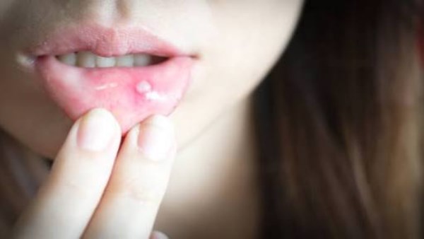 تحذيرات طبية بشأن التقرحات الفموية المستمرة
