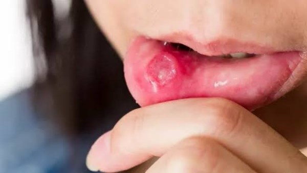 نشرة المرأة والمنوعات | علامة مبكرة لسرطان الفم أو الحلق .. مادة تعيد بناء الأسنان من الداخل وتفتح بابًا لعصر الشفاء الذاتي نشرة المرأة والمنوعات | علامة مبكرة لسرطان الفم أو الحلق .. مادة تعيد بناء الأسنان من الداخل وتفتح بابًا لعصر الشفاء الذاتي