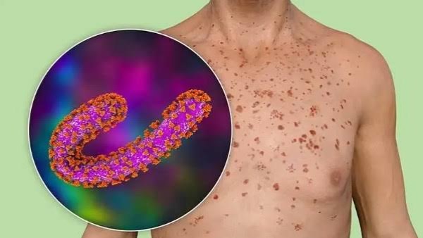 آلية عمل فيروس ماربورج داخل الجسم