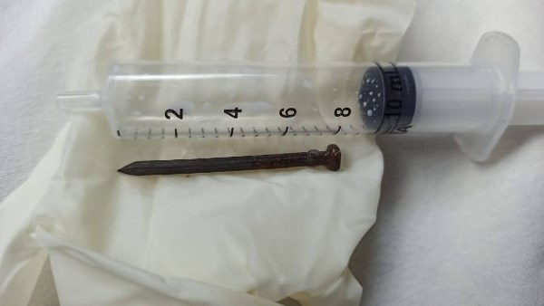 استخراج مسمار من أمعاء طفلة في المنوفية 