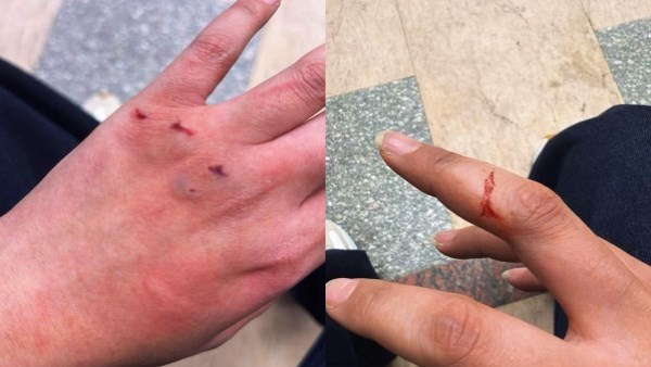 بعض إصابات الفتاة