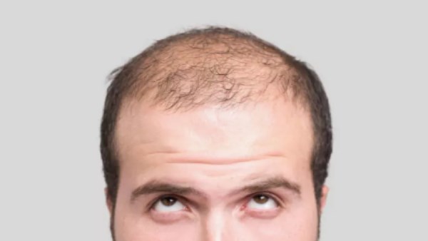 اكتشاف مصل جديد لإعادة نمو الشعر خلال 20 يومًا| تفاصيل