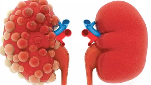 الفشل الكلوي: أعراضه وطرق الوقاية منه
