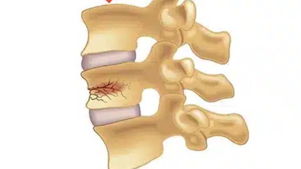أمل جديد.. نهج طبي واعد لعلاج كسور العمود الفقري| تفاصيل