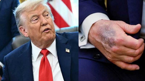 كدمات على يد ترامب