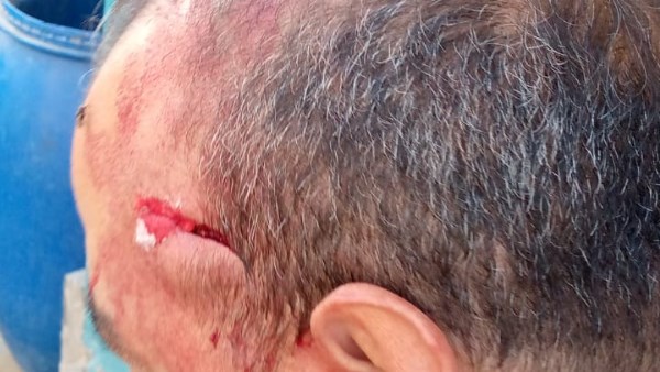 جرح قطعي في وجه المعلم 