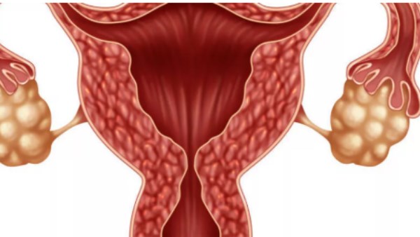 القرفة والكركم الأبرز.. 4 توابل تساعد في علاج متلازمة تكيس المبايض القرفة والكركم الأبرز.. 4 توابل تساعد في علاج متلازمة تكيس المبايض