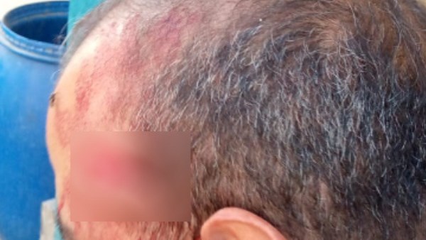 جرح قطعي في وجه المعلم 