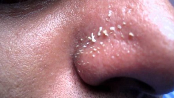 أسباب ظهور الرؤوس البيضاء في الوجه وطرق علاجها سريعا