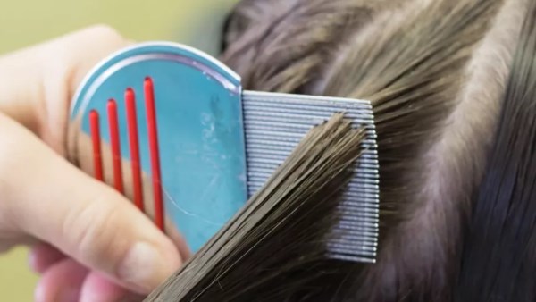  مشكلة شائعة فى المدارس..كيفية علاج قمل الرأس عند الأطفال