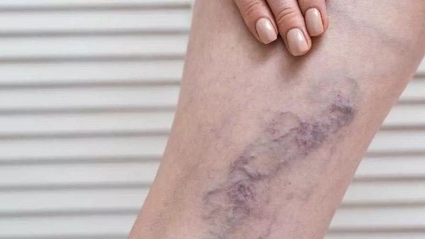 الجلطة الدموية في الساق احذر هذه العلامات و الاعراض