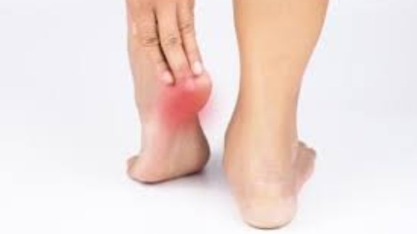 الشوكة العظمية .. اكتشف الأسباب الخفية وراءالتهاب اللفافة الحمضية