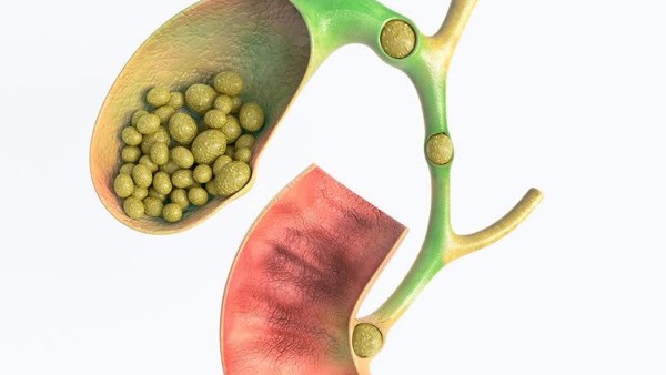 5 أعراض لا تتجاهلها تنذرك بمشكلة فى المرارة