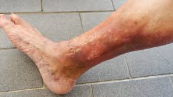  الأكزيما الوريدية 