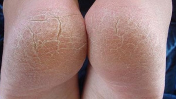 أبرزها الغدة الدرقية..عواما خفية وراء تشقق الكعب