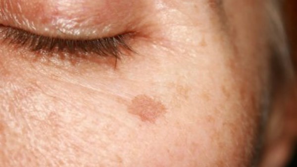 بقع الشمس أو بقع العمر: لماذا تظهر وكيف تحمي بشرتك منها؟