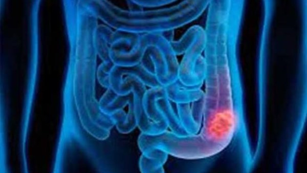 أعراض أولية للإصابة بسرطان القولون والمستقيم