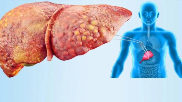 هل يمكن علاج الكبد الدهني المبكر ؟