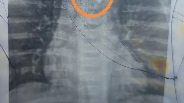 زلطة في المريء