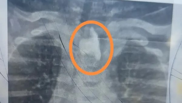 زلطة في المريء