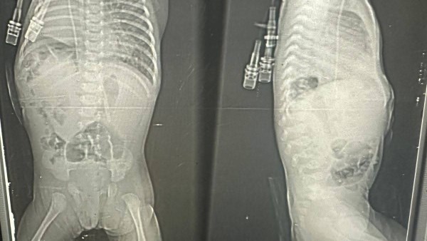 أشعة الطفلة 