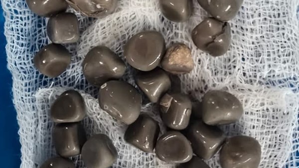 جراحة دقيقة .. مستشفى قنا الجامعى يستخرج 58 حصوة بكلية مريض أربعينى