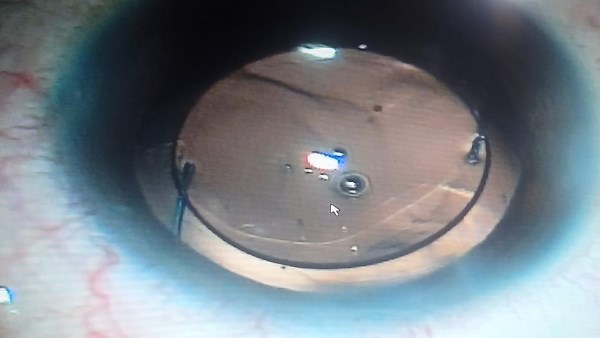 انقاذ عين مريضه 