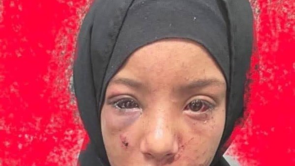 الطفلة شيماء