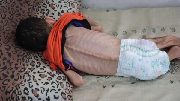 سوء التغذية يفتك بأجساد أطفال غزة