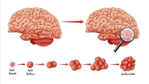 مرض صامت.. تعرف على اعراض سرطان المخ