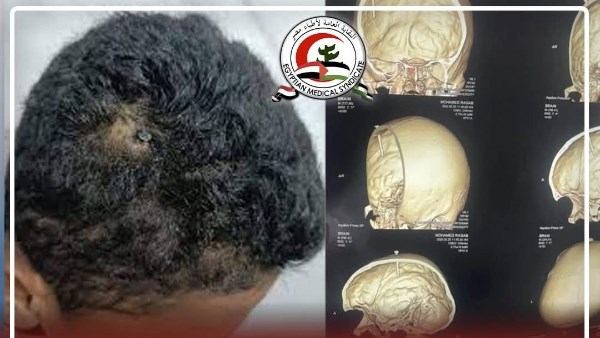 صورة الطفل الذي خرق المسمار رأسه 