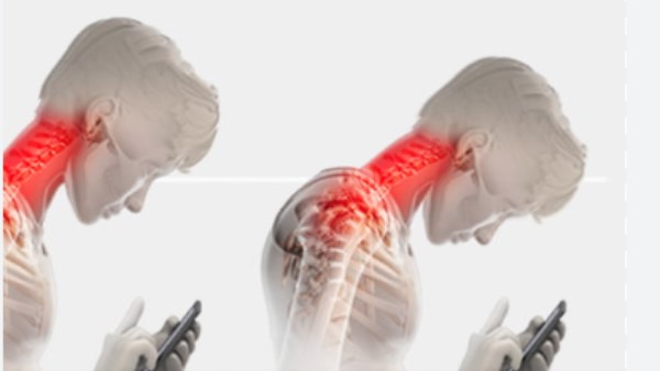 متلازمة الرأس المتدلي