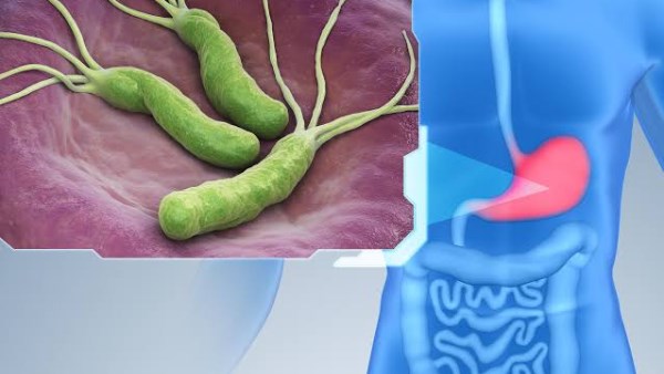 التغذية العلاجية تُعزز فعالية علاج جرثومة المعدة ولا تُغني عن العلاج الدوائي